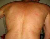 photo of a man's back covered with bed bug bites