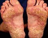 photo of severe case of psoriasis on feet