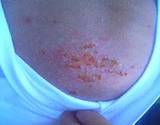 photo of woman with sunburn blister on chest needing natural sunburn relief